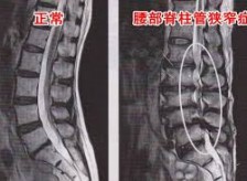 腰部脊柱管狭窄症の患者様が来院されました。