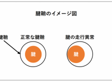 腱鞘炎の患者様が来院されました。