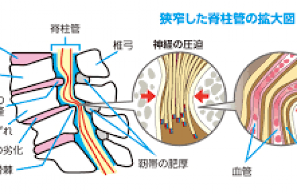 狭窄症