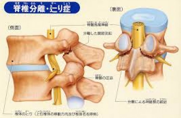 脊椎分離すべり症の症状