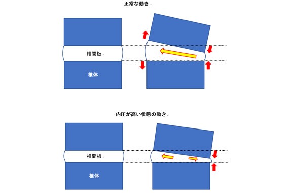 椎間板ヘルニア