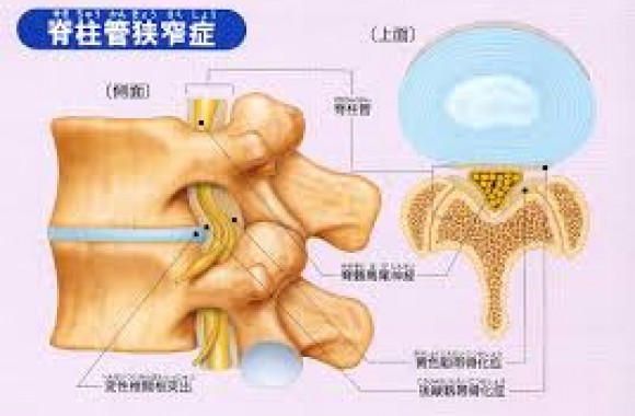 狭窄症