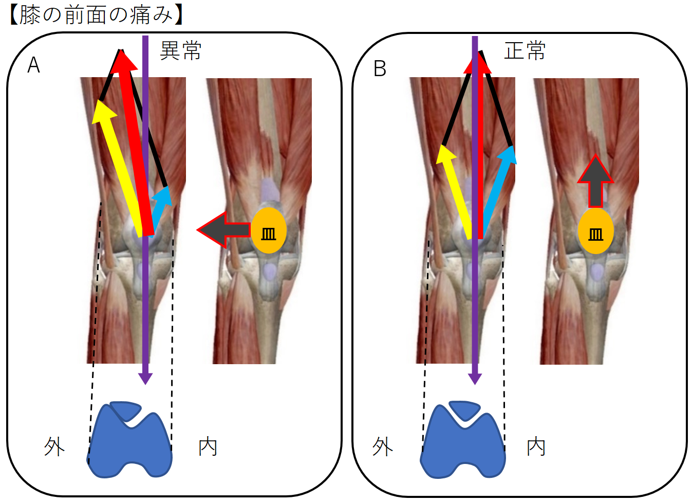 膝の内側の痛みを治すエクササイズ